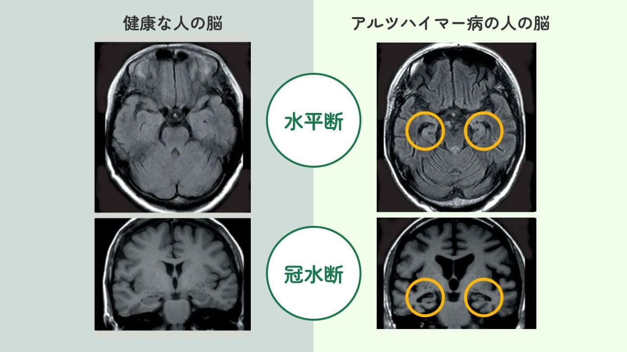 健康な人の脳画像とアルツハイマー病の人の脳画像の比較図