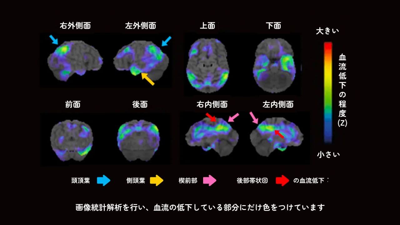 認知症の人のSPECT検査における血流の状態を表した画像