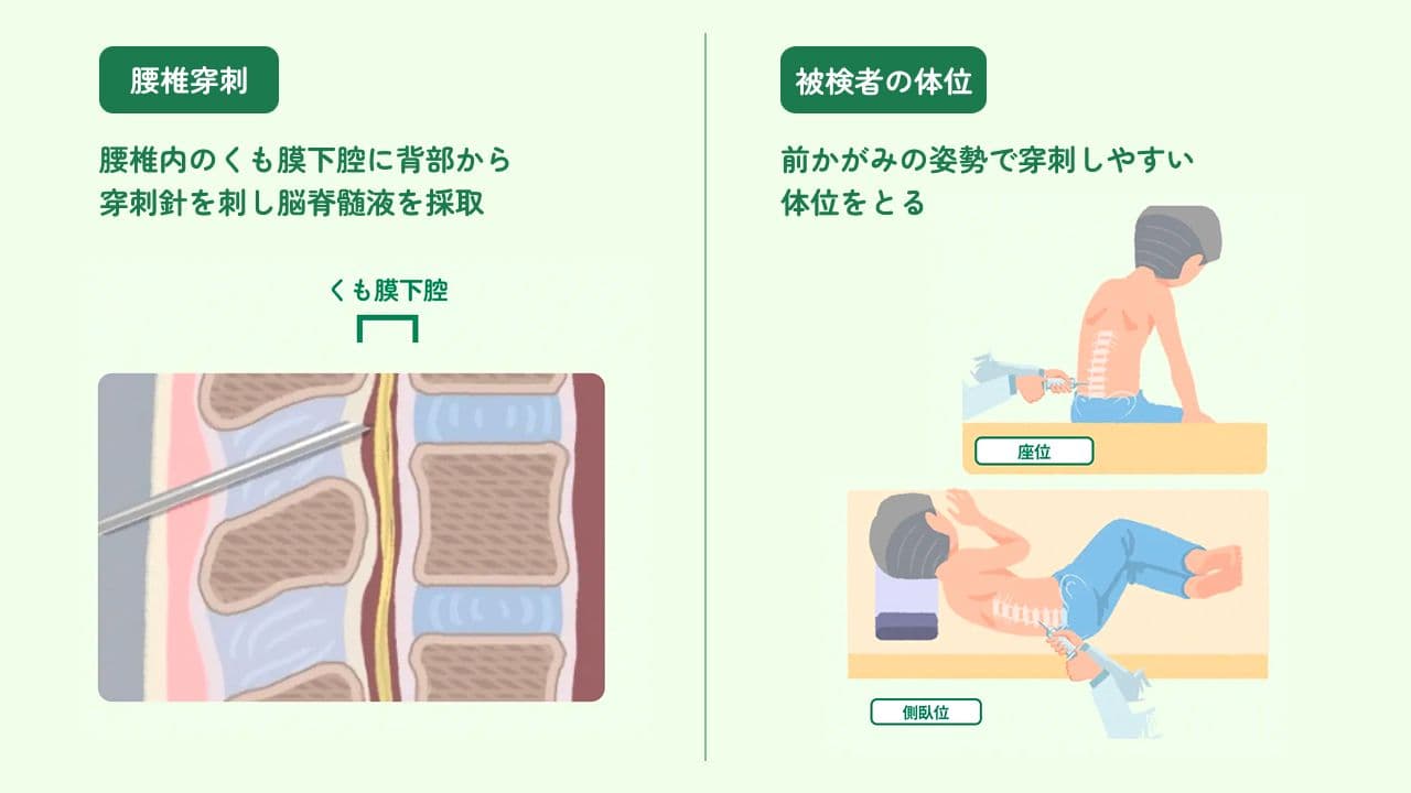 腰椎穿刺検査の説明・穿刺する際の体位のイメージ図