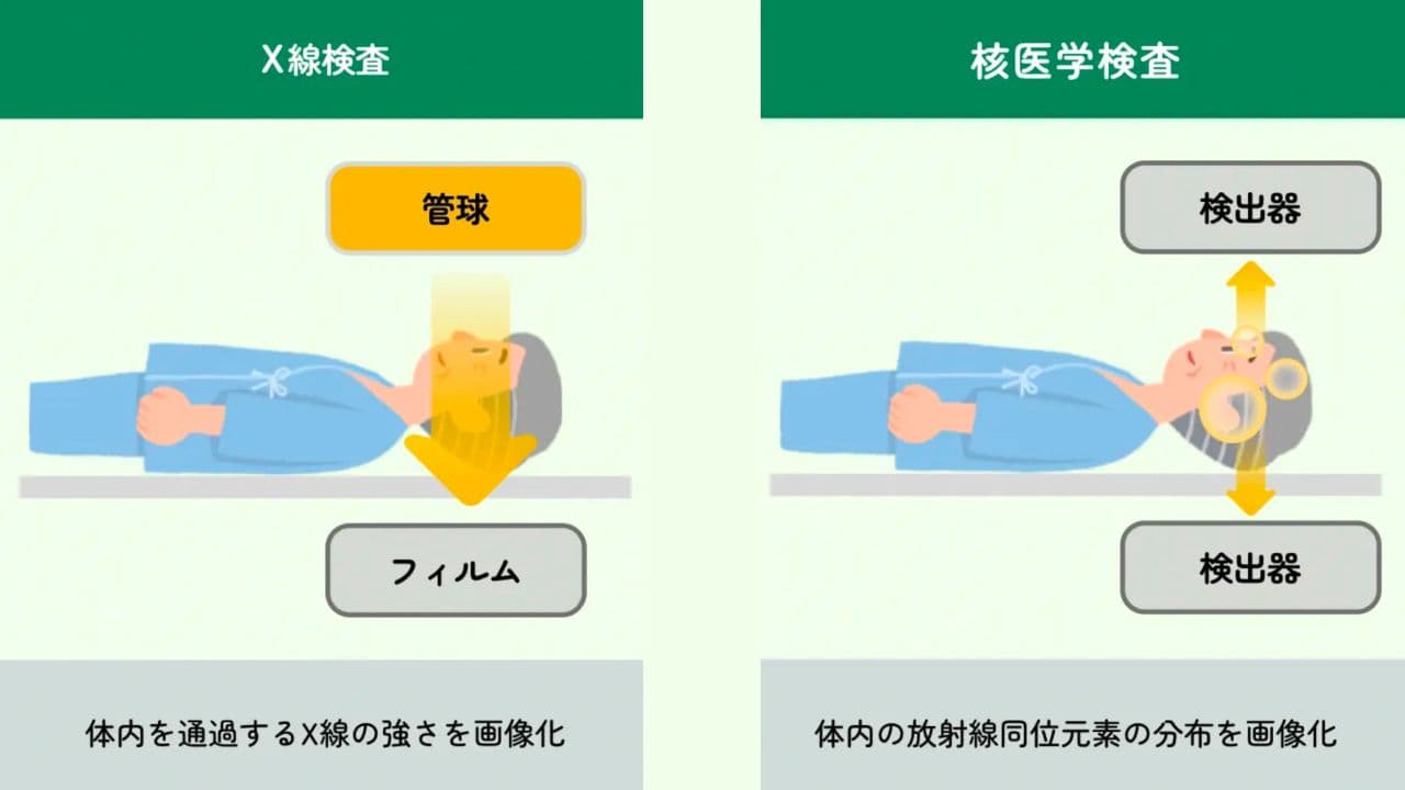 X線検査と核医学検査の違いのイメージ図