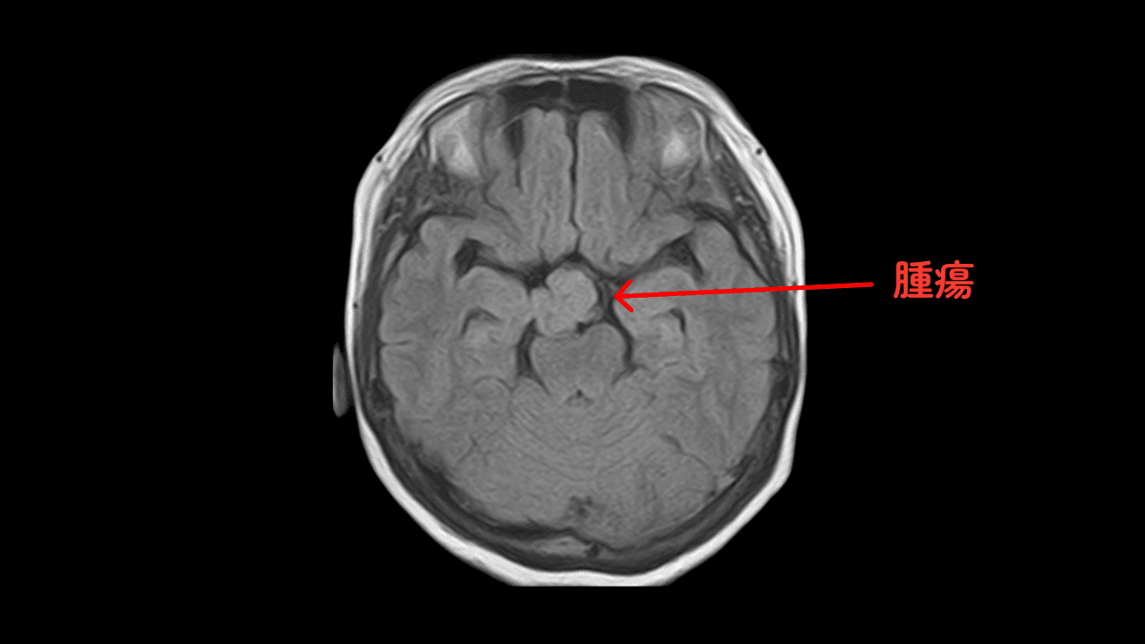 頭部MRIで見た脳腫瘍
