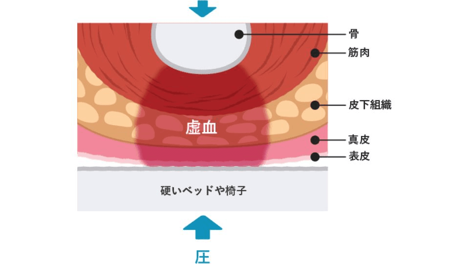 褥瘡(じょくそう)を知ろう。床ずれの症状と処置方法