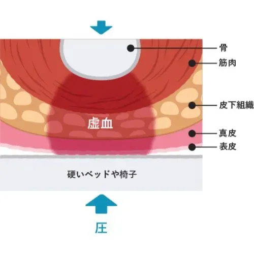 褥瘡（じょくそう）を知ろう。床ずれの症状と処置方法