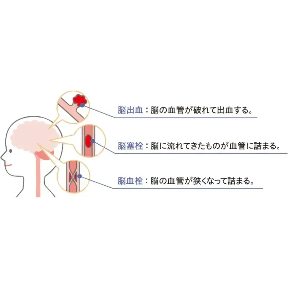 血管性認知症とは？原因と症状