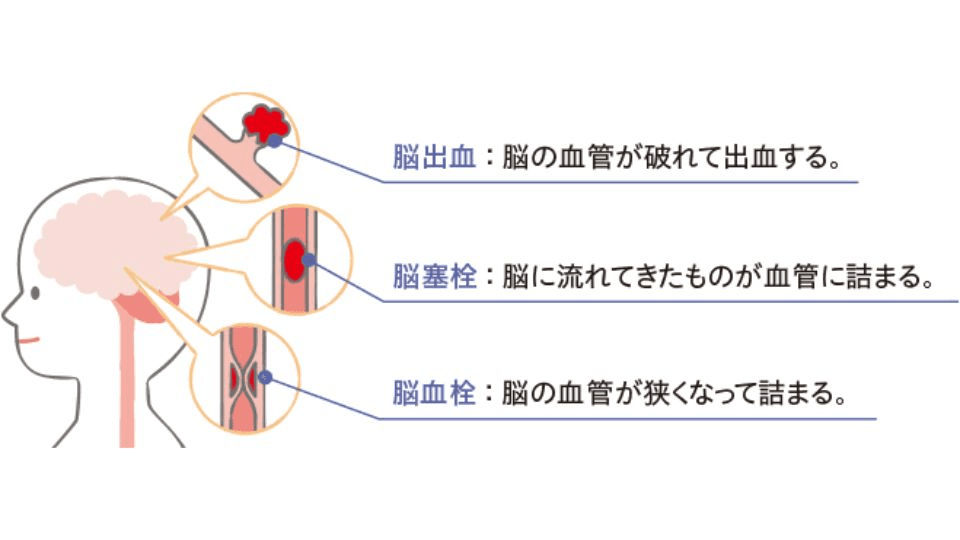 血管性認知症とは？原因と症状