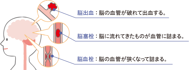 脳出血：脳の血管が破れて出血する。