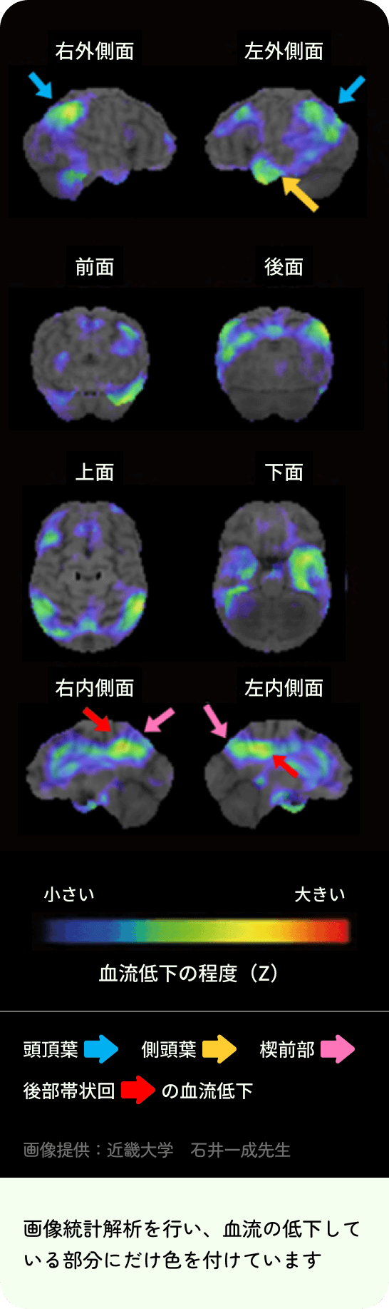 画像統計解析で、さまざまな角度からの血流が低下している部分に色をつけてわかるようにしたSPECT画像。